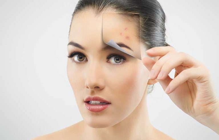 Acne-Treatment-02-768x490